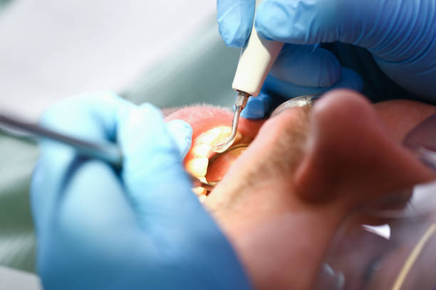 Best Emergency Dental Extractions in Wilton Center, CT