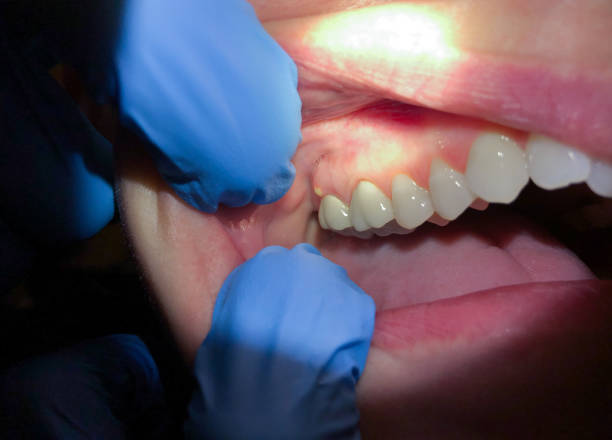 Best Emergency Dentist for Knocked-Out Tooth in Wilton Center, CT